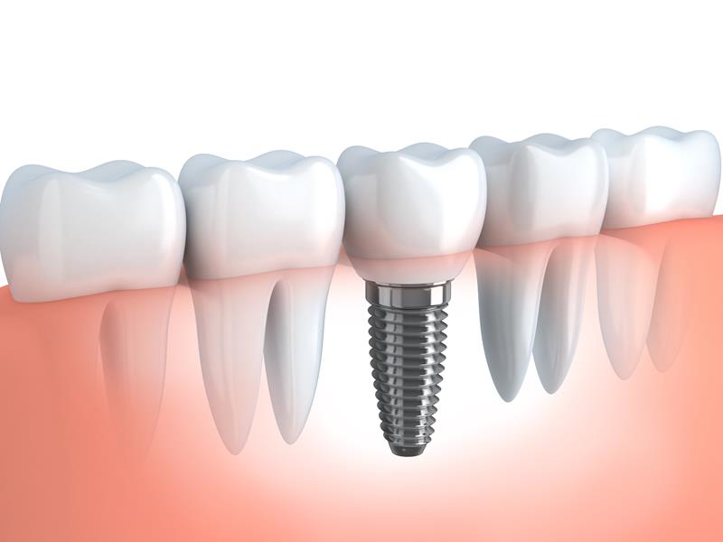 Dental Implants  Dillon, CO 